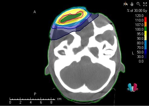 Planning CT with isodose lines: dose distribution over the area treated with BolusCare